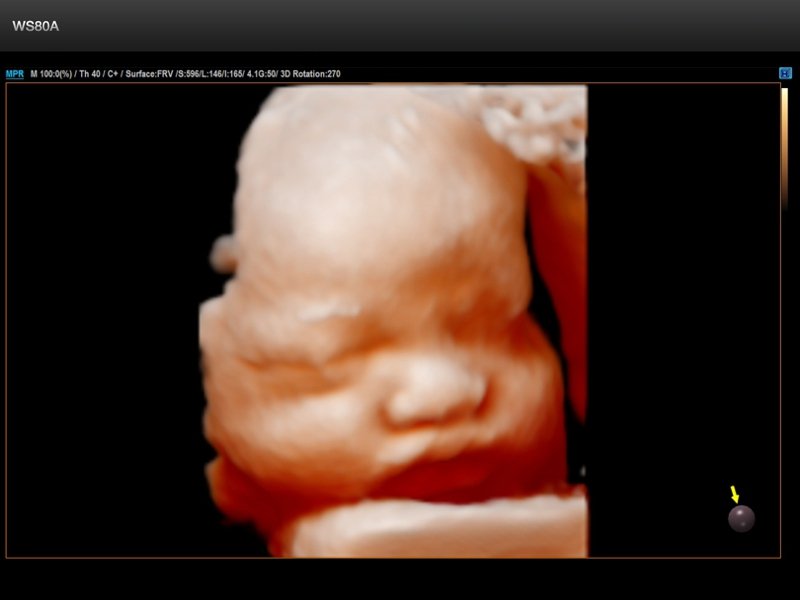 Fetal face, Realistic Vue 3D (echogramm №662)
