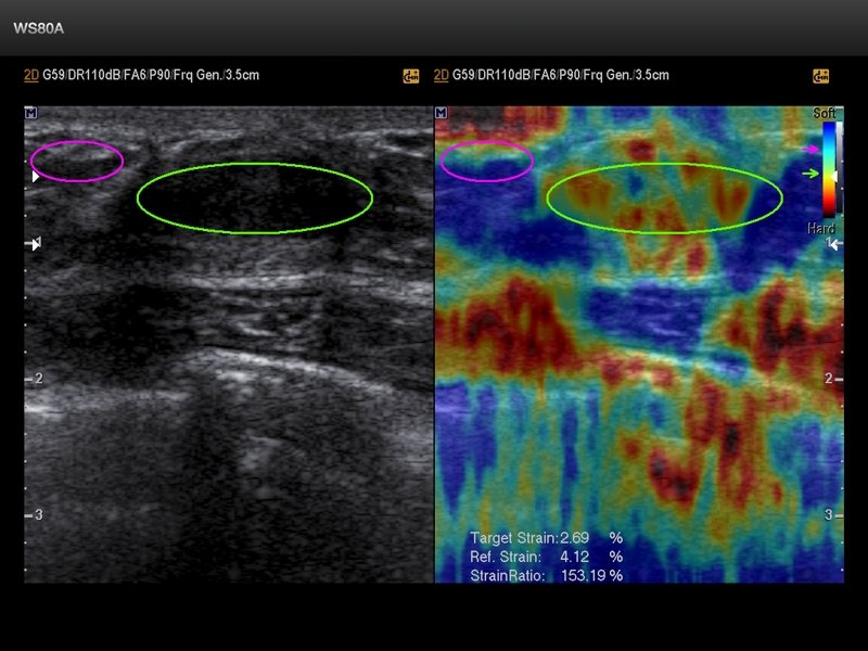 Breast, elastography (echogramm №664)