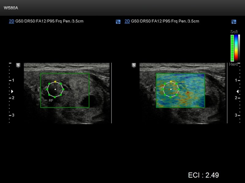 Thyroid, elastography (echogramm №665)