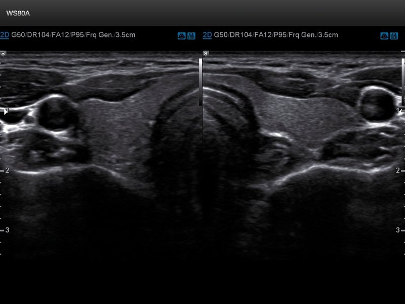 Thyroid, В/В (echogramm №666)