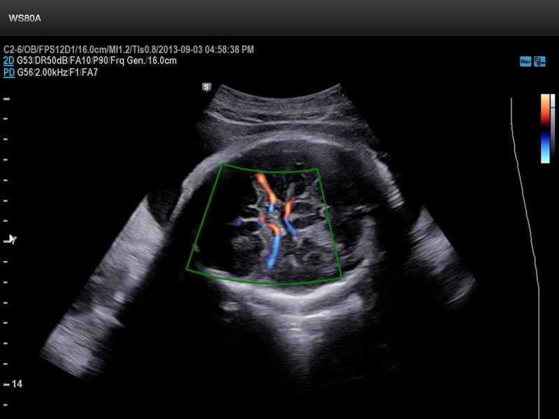 Fetus - middle cerebral artery, S-Flow (echogramm №668)