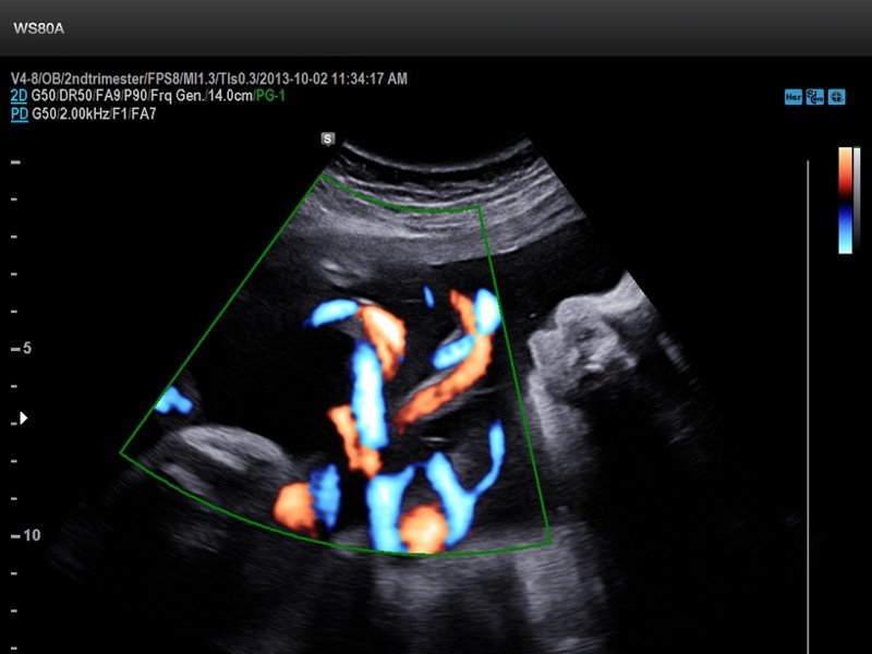 Umbilical cord, S-Flow (echogramm №669)