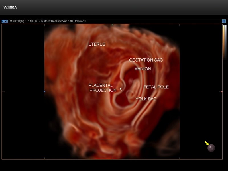 Embryo, Crystal Vue 3D (echogramm №670)