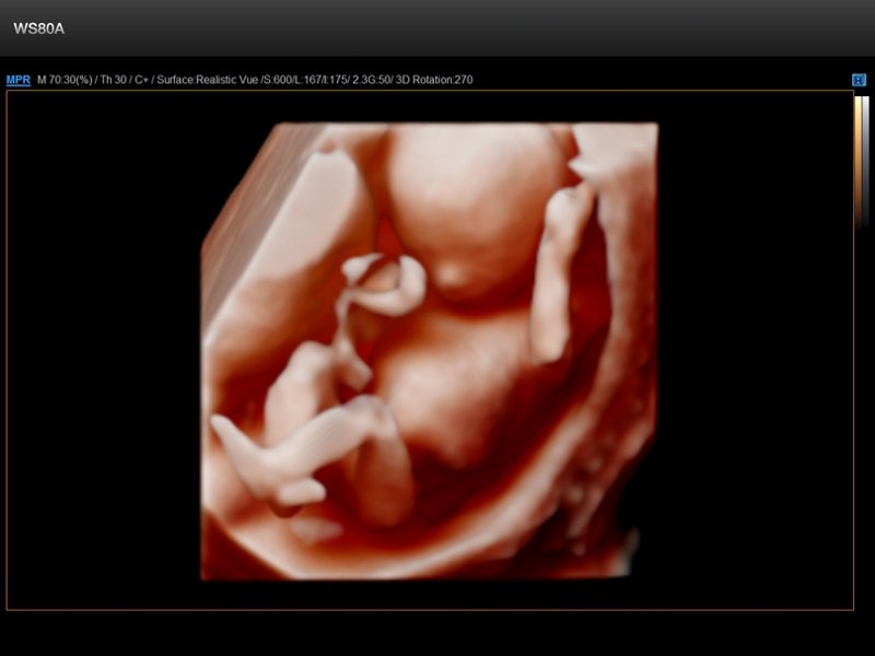 Fetus - 14 weeks, Realistic Vue 3D (echogramm №671)