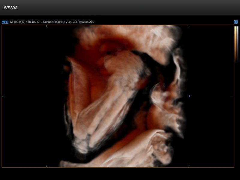 Fetus - ulna and radius, Crystal Vue 3D (echogramm №672)