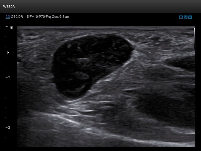 Muscle - volumetric formation, B-mode (echogramm №674)