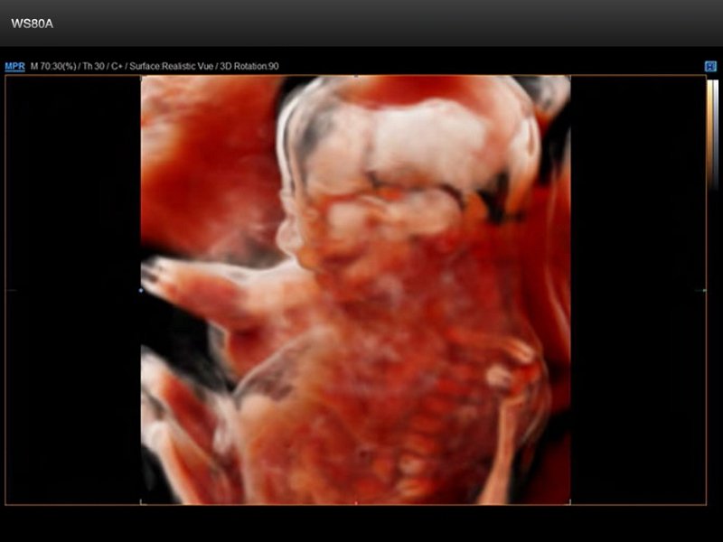 Fetus - 21 weeks, Realistic Vue 3D (echogramm №675)