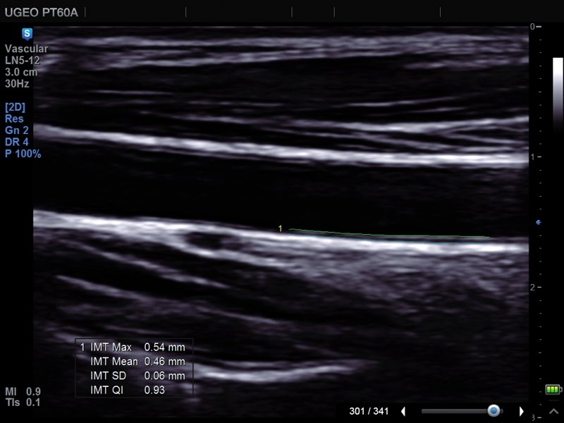 Common carotid artery, Auto IMT (echogramm №677)