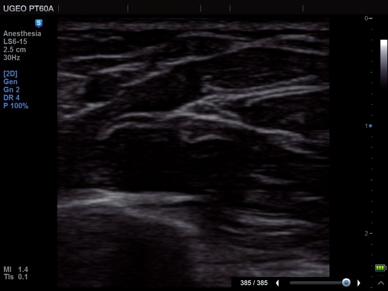 Median nerve, MultiVision (echogramm №679)