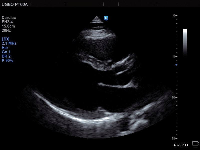 Heart (long axis of LV), B-mode (echogramm №680)