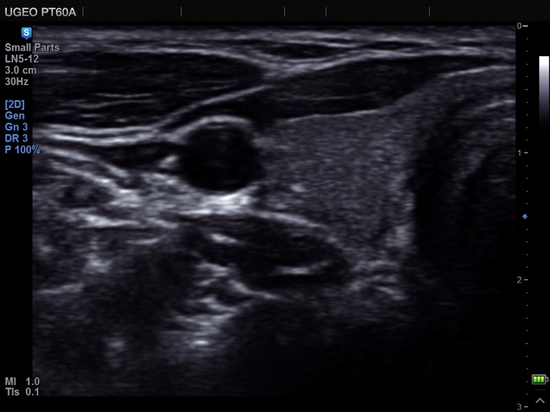 Thyroid, MultiVision (echogramm №681)