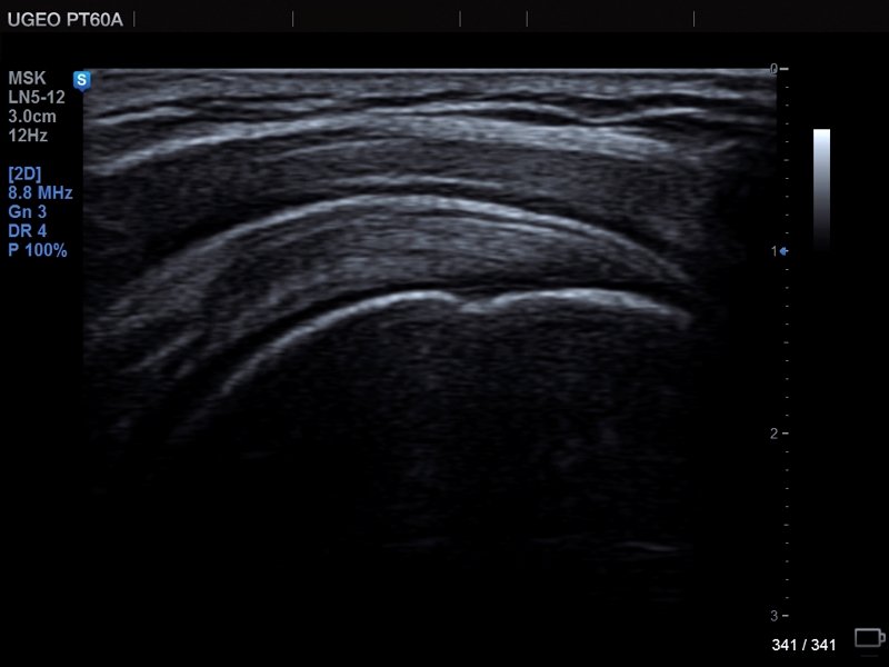 Supraspinatus tendon, MultiVision (echogramm №683)