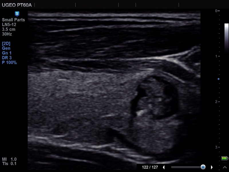 Thyroid - nodule, ClearVision (echogramm №684)