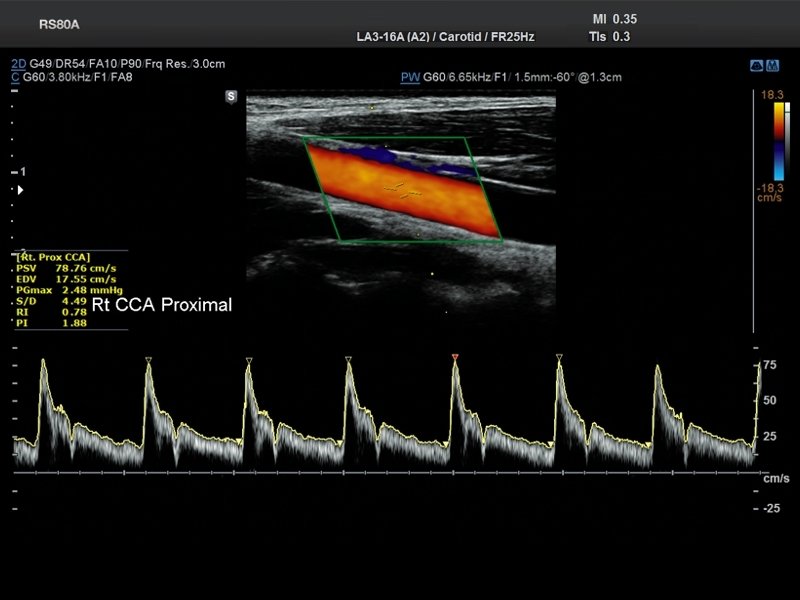 Common carotid artery, CFM & PW (echogramm №686)