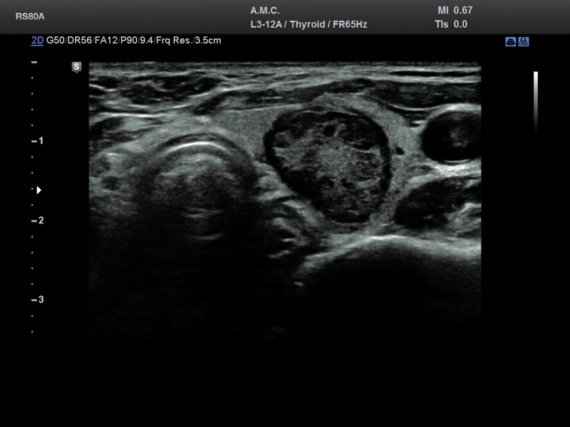 Thyroid - nodule, B-mode (echogramm №688)