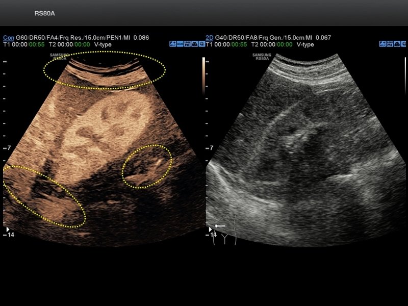 Kidney, CEUS+ and FlowMax (echogramm №694)