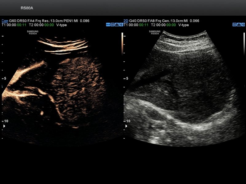 Liver, CEUS+ (echogramm №695)