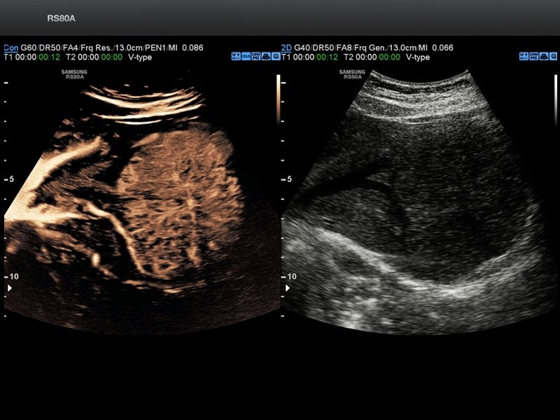 Liver, CEUS+ and VesselMax (echogramm №696)