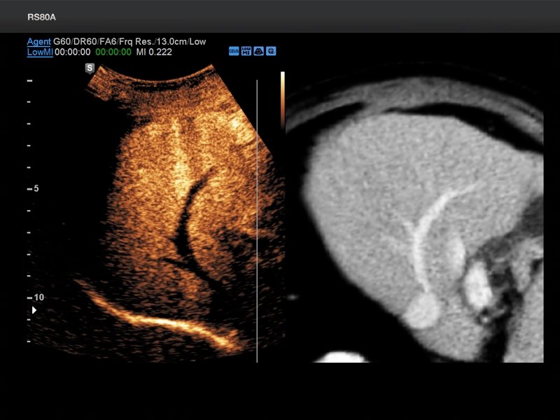 Liver, S-Fusion with CEUS+ (echogramm №697)