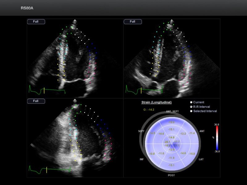 Heart - left ventricle, Strain+ (echogramm №699)