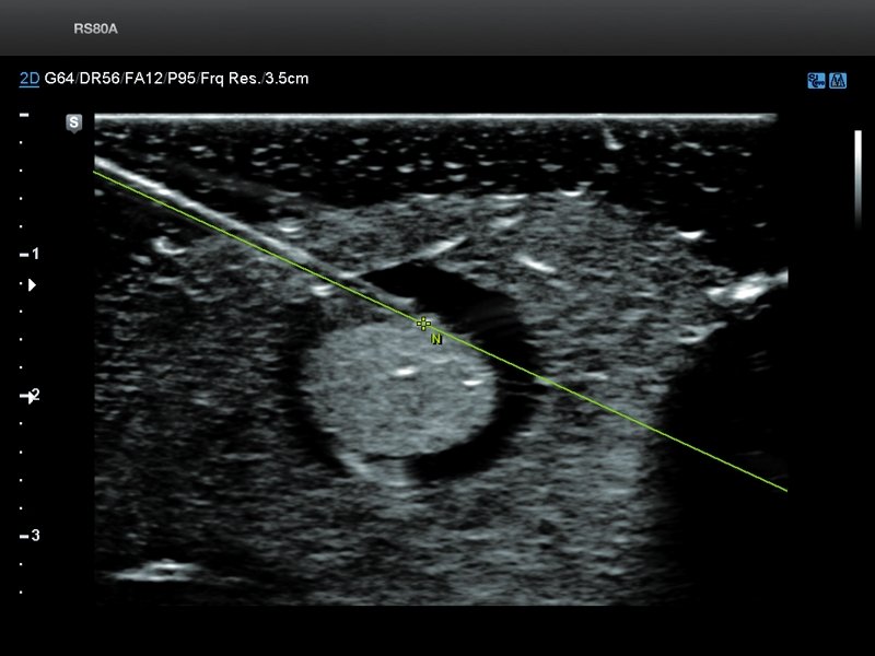 Thyroid, S-Tracking (echogramm №703)