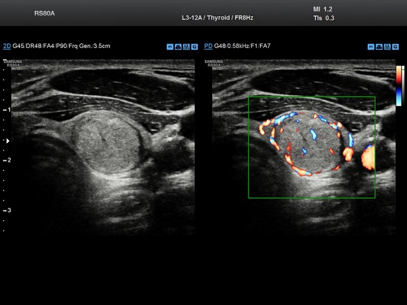 Thyroid - nodule, power doppler (echogramm №704)