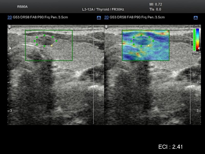 Thyroid, elastography (echogramm №705)