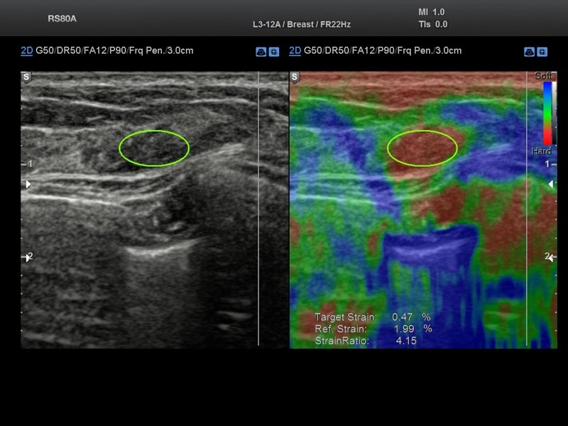 Breast, elastography (echogramm №706)