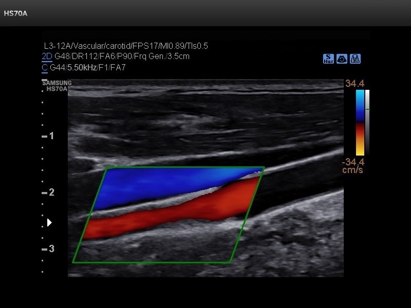 CCA and jugular vein, color doppler (echogramm №709)