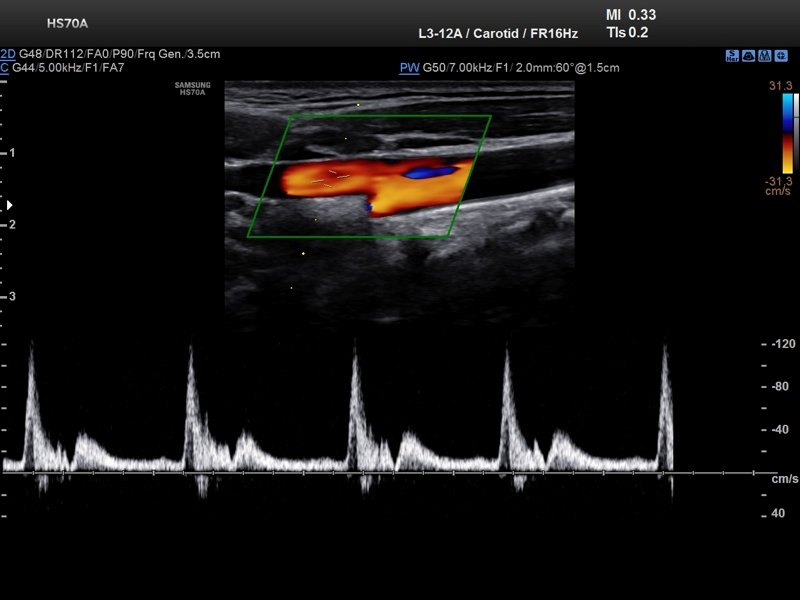 Common carotid artery, CFM & PW (echogramm №710)