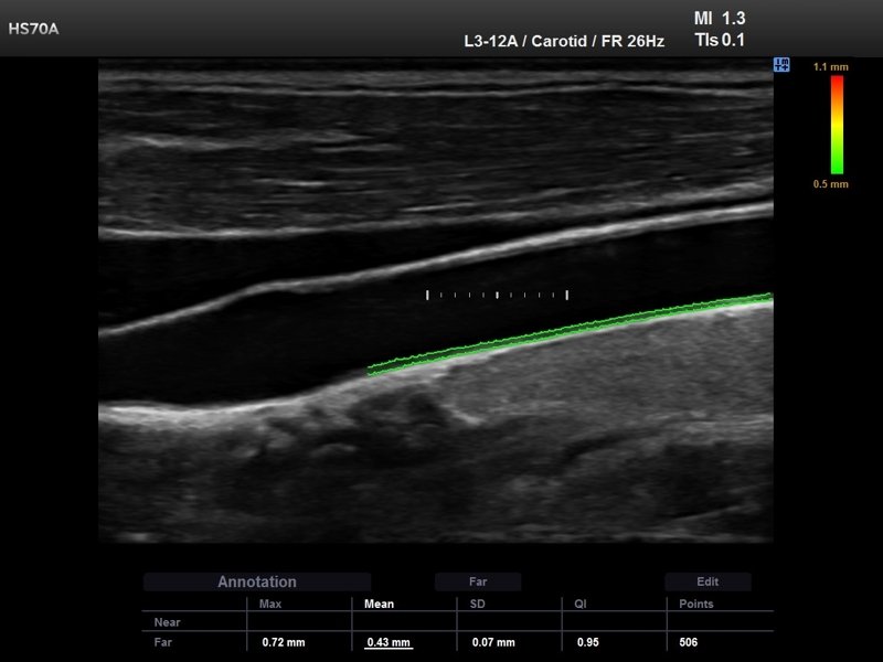 Common carotid artery, Auto IMT (echogramm №711)