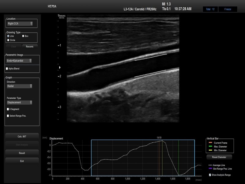 Common carotid artery, Arterial analysis (echogramm №712)