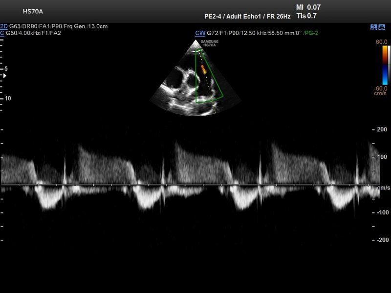 Pulmonary regurgitation, CFM & CW (echogramm №714)