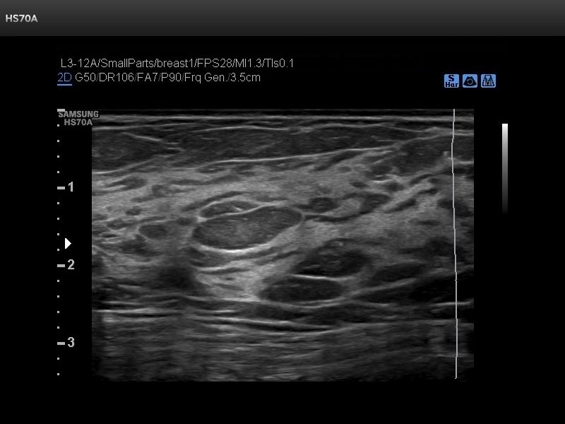 Breast, S-Harmonic (echogramm №715)