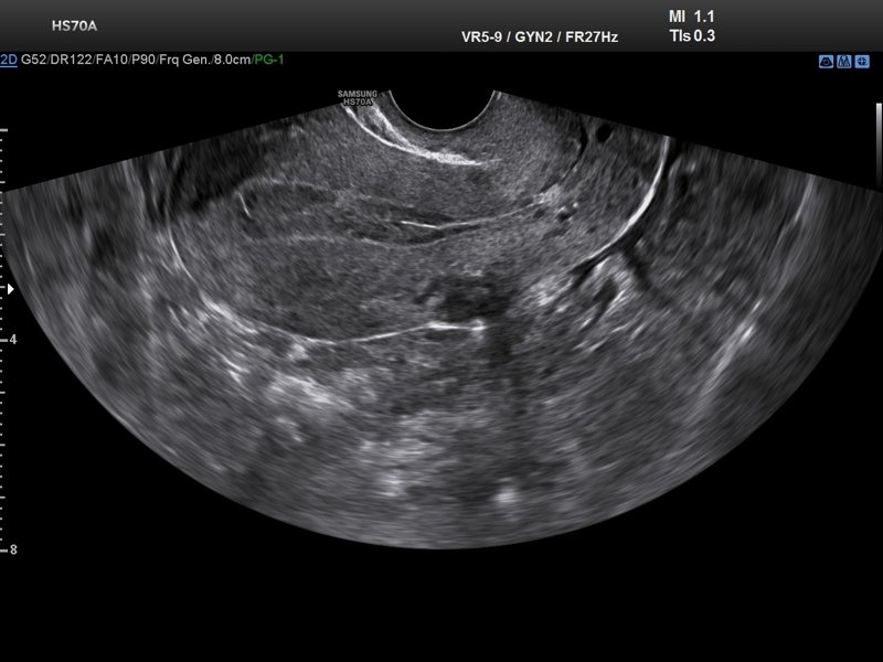 Uterus, B-mode (echogramm №716)