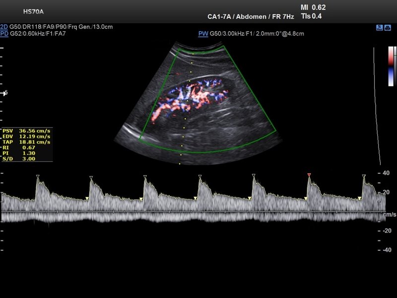 Kidney, CFM & PW (echogramm №717)