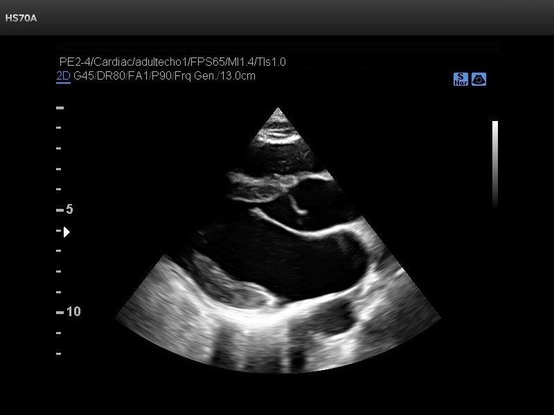 Heart (long axis of LV), B-mode (echogramm №718)