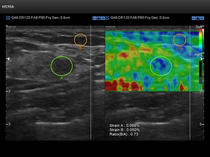 Breast, elastography (echogramm №719)