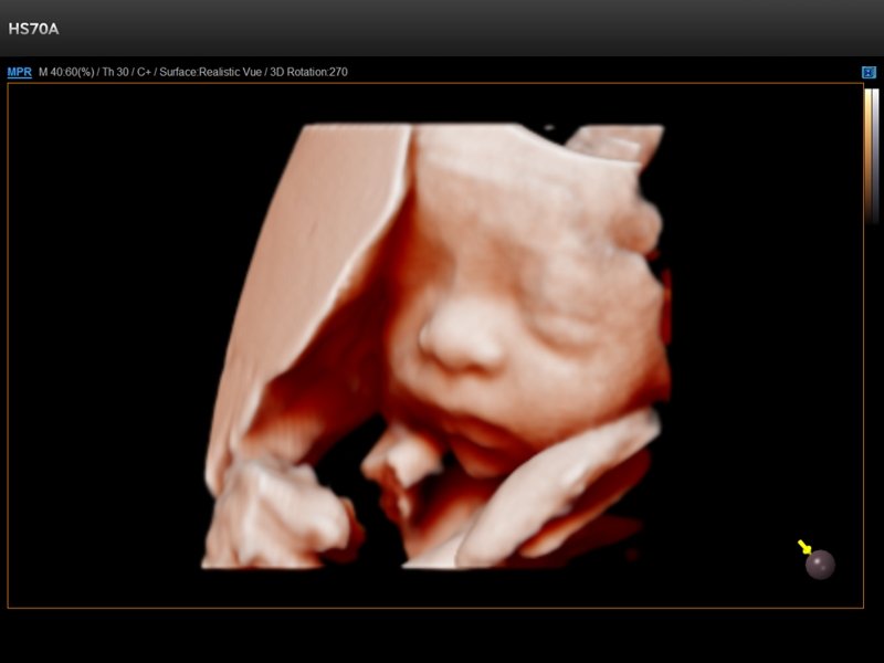 Fetus - face, Realistic Vue 3D (echogramm №721)