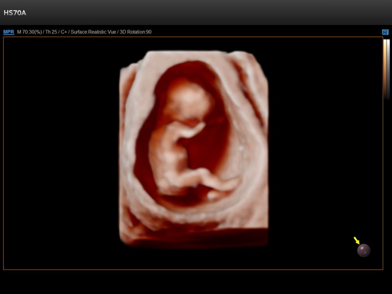 Fetus, Realistic Vue 3D (echogramm №722)
