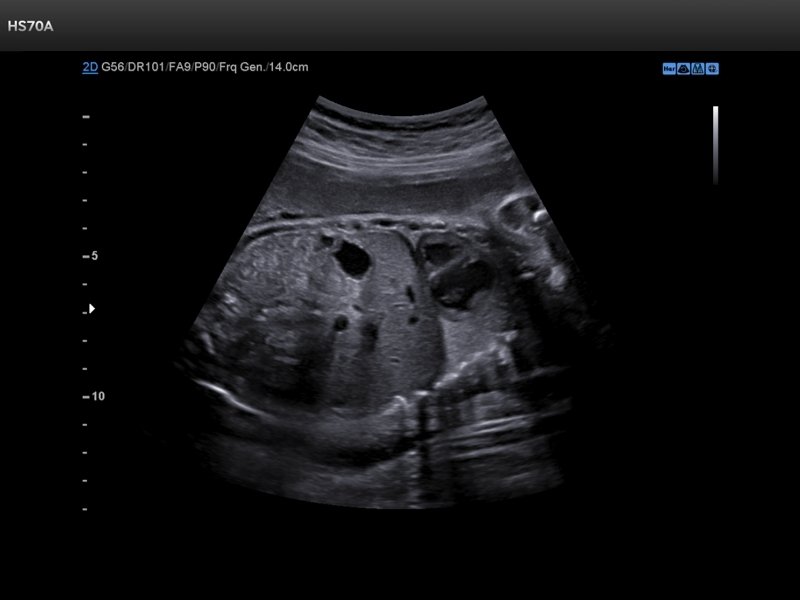 Fetus - abdomen, B-mode (echogramm №723)
