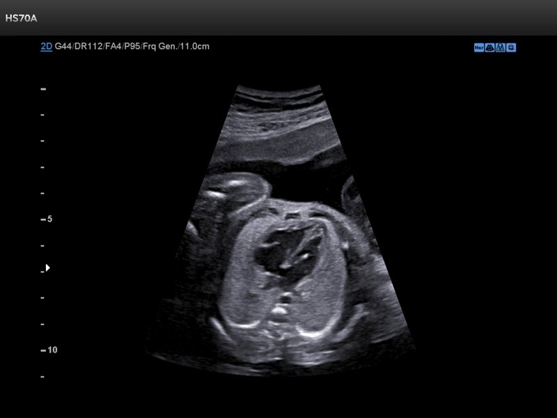 Fetal heart, B-mode (echogramm №724)