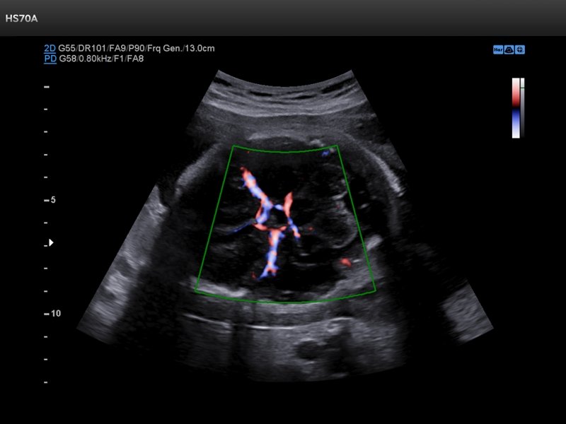 Fetal brain, S-Flow (echogramm №725)