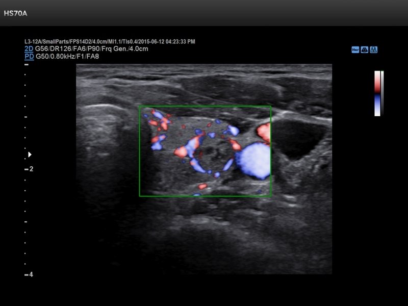 Thyroid - nodule, S-Flow (echogramm №726)