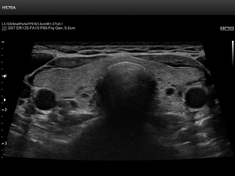 Thyroid, B-mode (echogramm №727)