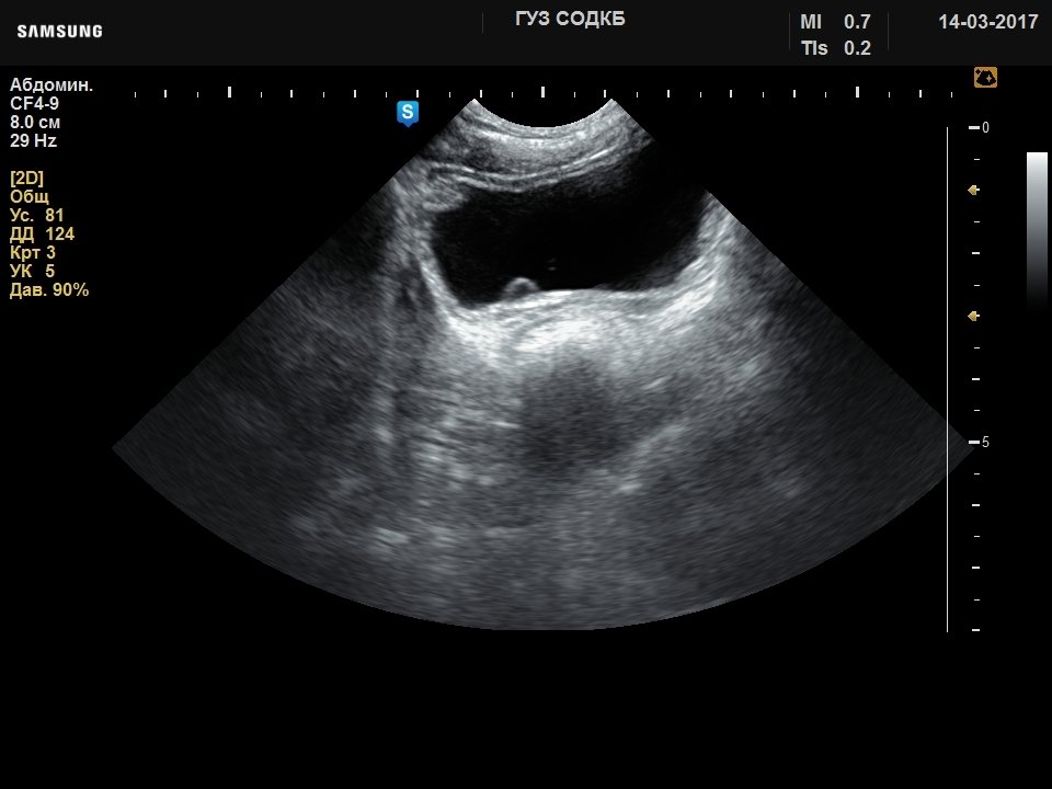 Urinary bladder - ureterocele, B-mode (echogramm №728)