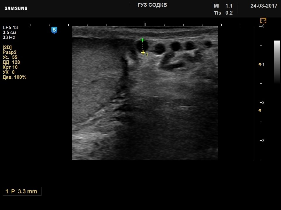 Testicle - varicocele, B-mode (echogramm №729)