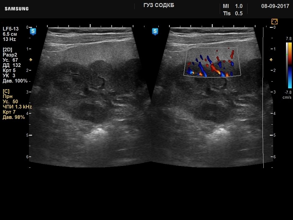 Kidney - nephroblastomatosis, B-mode & color doppler (echogramm №730)