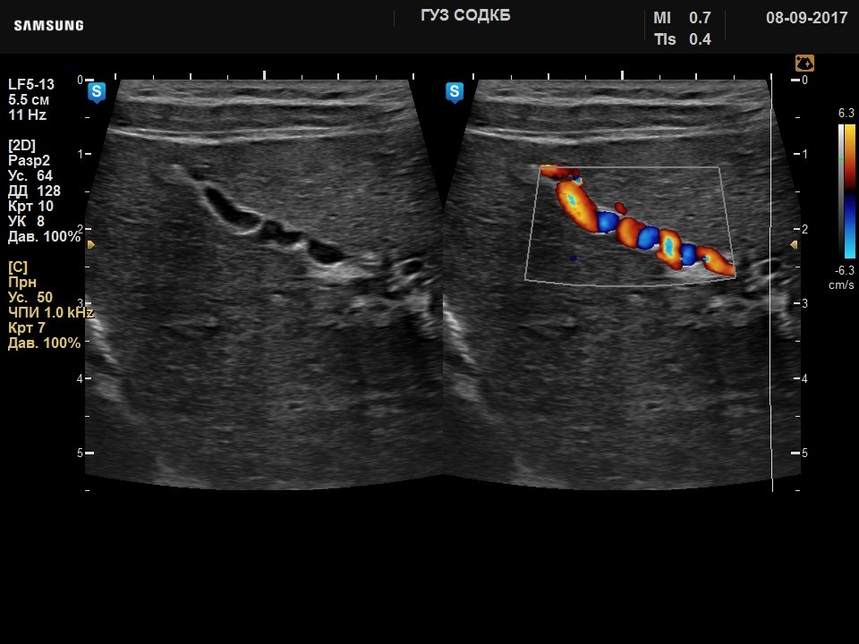 Liver - autoimmune hepatitis, B-mode & color doppler (echogramm №731)