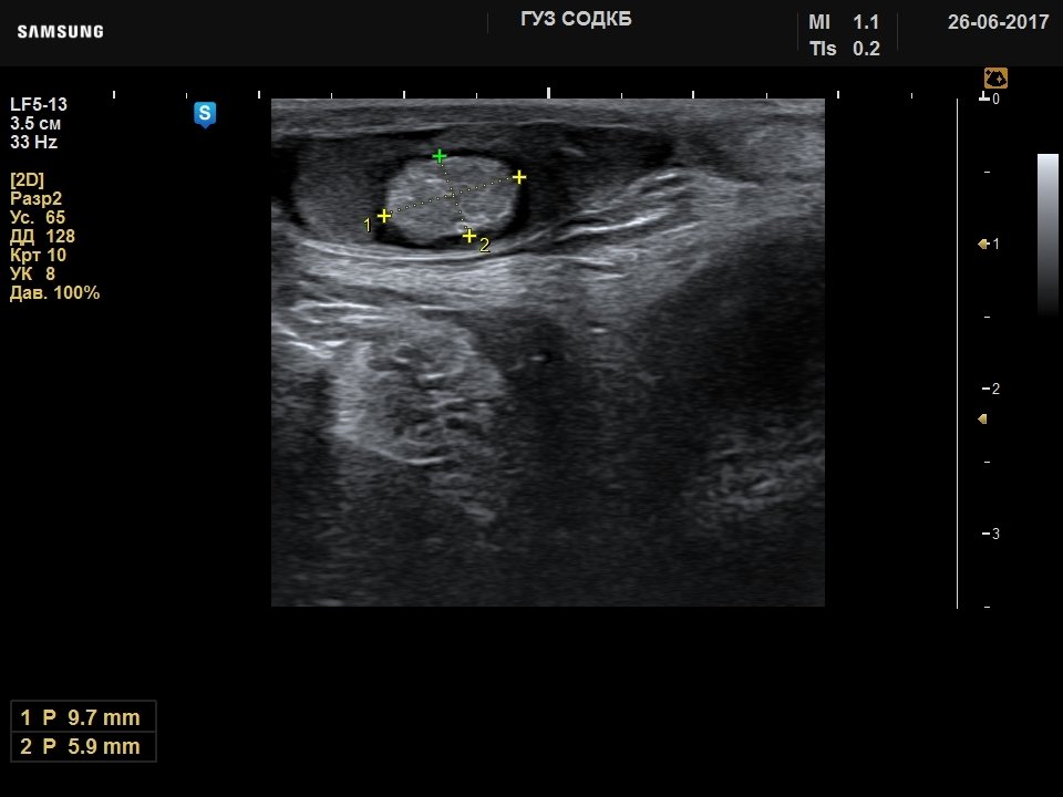 Testicle - dermoid cyst, B-mode (echogramm №732)